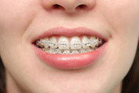 adultbraces