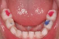 coloredfillings
