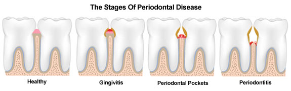 gumdiseasetreatment