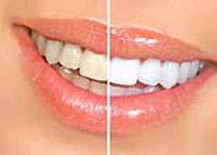 inofficewhitening