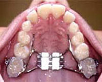 interceptivebraces