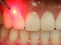 lasersurgery