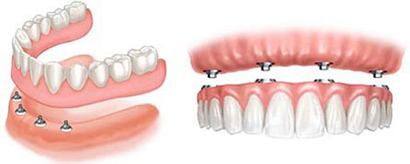 miniimplants