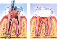 rootcanal