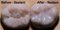 toothsealants2
