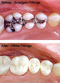 whitefillings