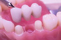 dentalbridges